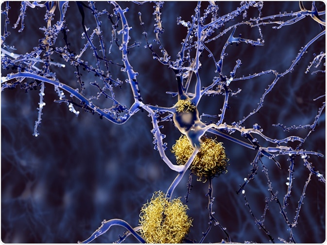 Alzheimer disease: neuron with amyloid plaques. Image Credit: Juan Gaertner / Shutterstock